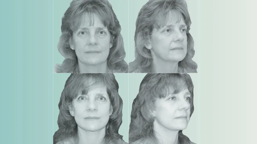 Kimberly Bongiorno pictured before (top) and after (bottom) her face and neck lift. Photo Illustration/CNN/Berlet Plastic Surgery